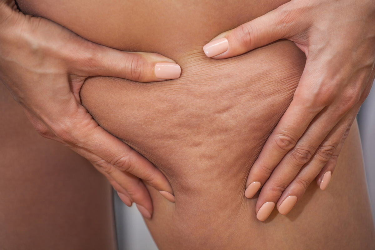 Cellulite: Wie sie entsteht und was du tun kannst - Ein Experteninterview