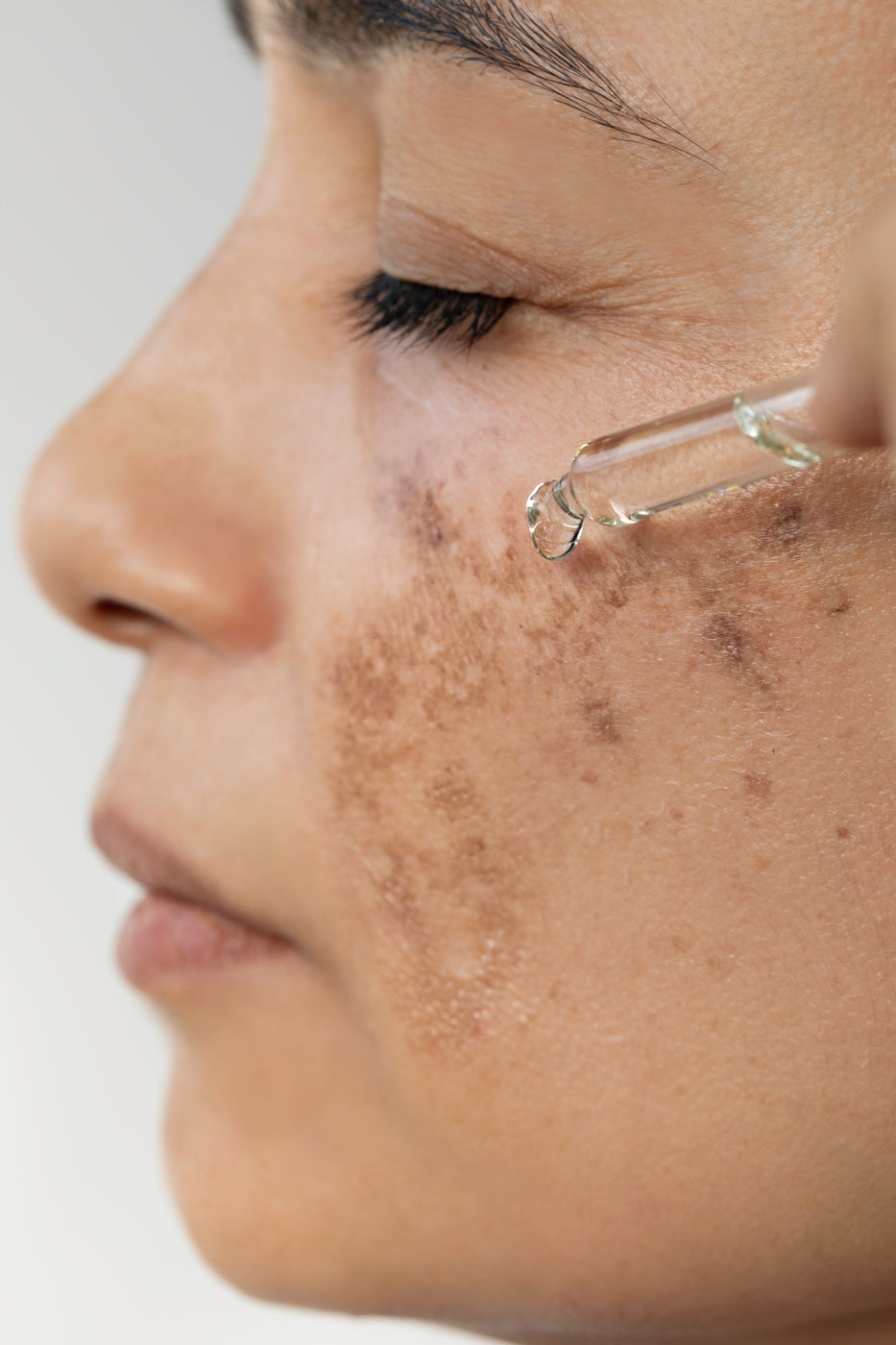 Primo piano di un viso femminile di profilo con zone screpolate sulla guancia su cui viene applicato del siero