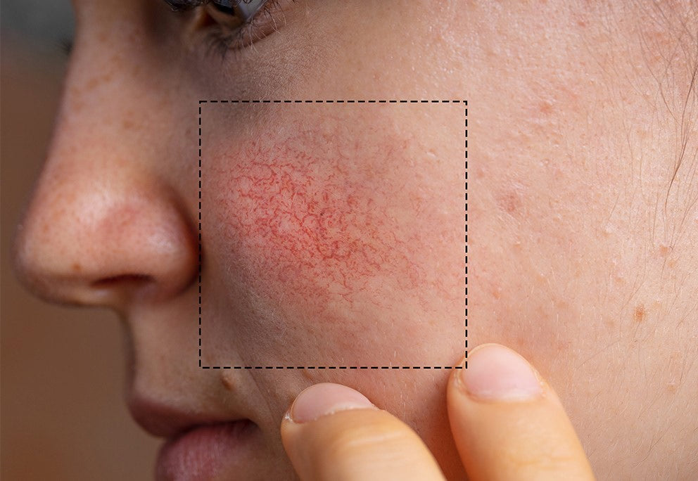 Viso con area rosacea evidenziata sulla guancia