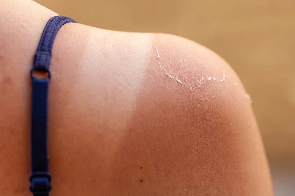 Primo piano di una spalla con scottatura solare e pelle che si stacca