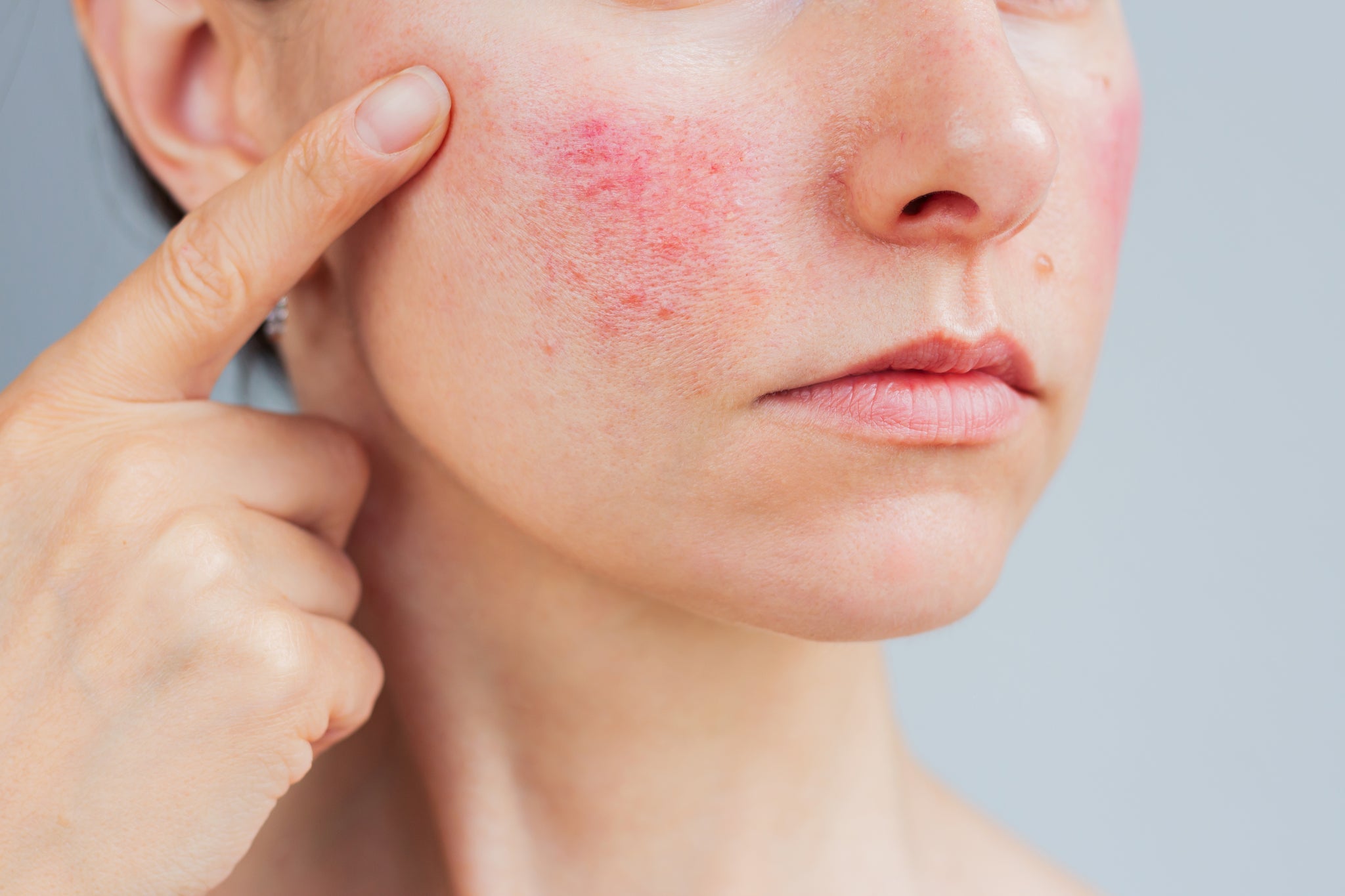 Rosacea sulla guancia